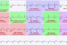 leads for ekg